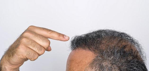 صورة كيفية المحافظة على الشعر من التساقط للرجال