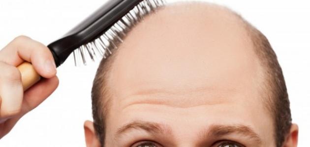 6143385381c75 كيف تعالج تساقط الشعر عند الرجال