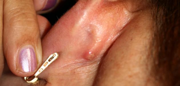 صورة التهاب الغدد اللمفاوية خلف الأذن