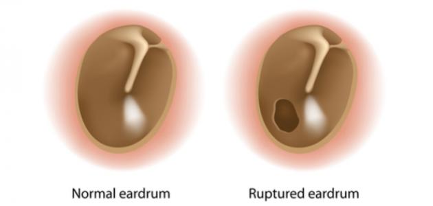 صورة علامات ثقب طبلة الأذن